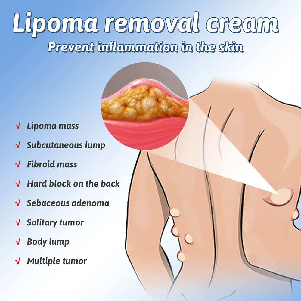 QB™ Herbal Lipoma Removal Cream (50gm) - ✅Doctors Recommended