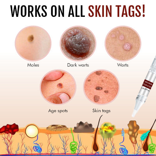 Tags & Warts Remover ( BUY 1 GET 1 FREE )